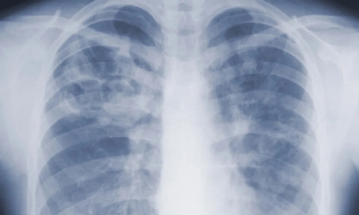 New Study Warns of Hidden Risks of Mold-Related Diseases in Santurce